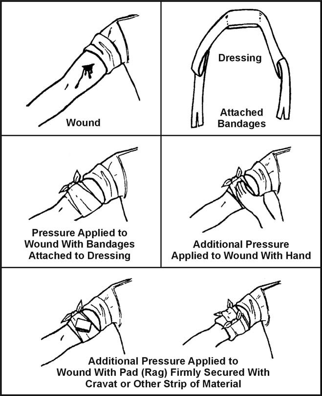 Figure 4-2. Application of a Pressure Dressing